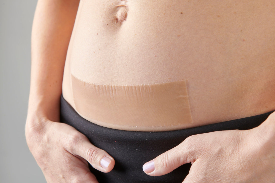 Lara Hofer, Founder of myscar., Shares Her Caesarean Birth Story
